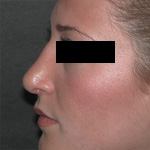 Image of patient's nose after rhinoplasty