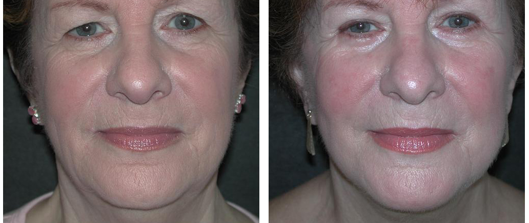 local toronto female before and after facelift procedure
