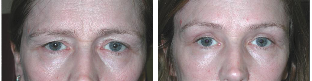 toronto female with browlift procedure from doctor richard rival