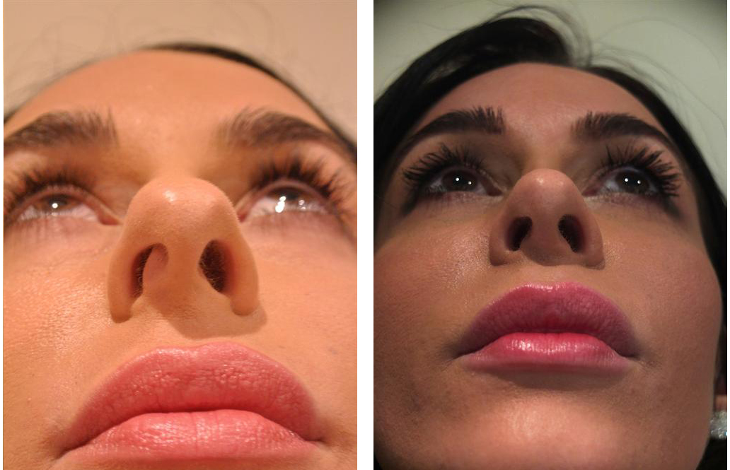 The best rhinoplasty surgeon in Toronto before and after