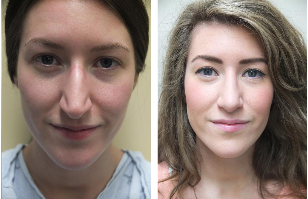 Before and after photo of female Toronto Rhinoplasty by Dr. Rival