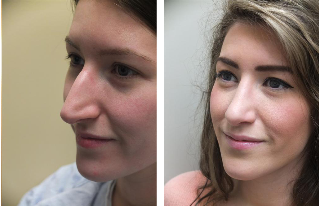 Dr. Rival Rhinoplasty on Toronto Patient