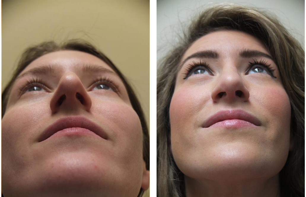 Before and After Rhinoplasty by Dr. Richard Rival
