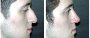 white male before and after rhinoplasty