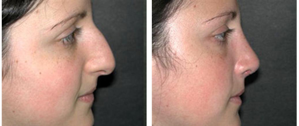 side view of toronto nosejob on a young female
