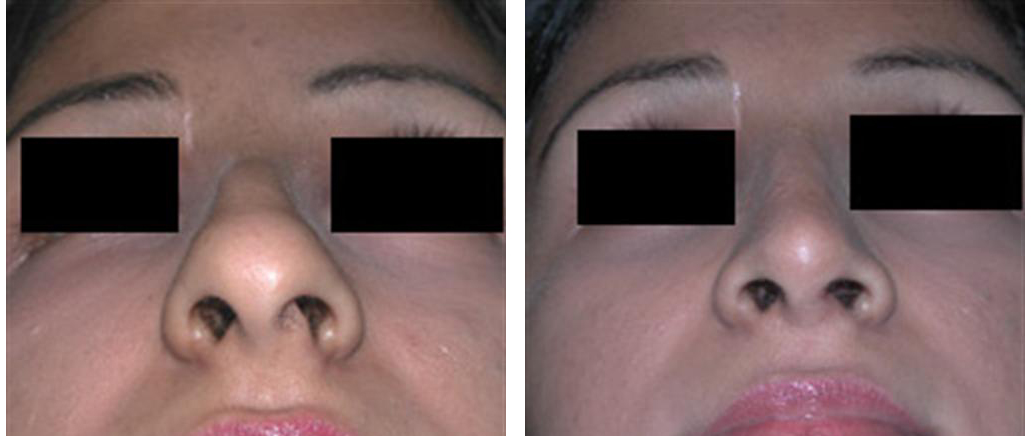 Toronto rhinoplasty on young female by Dr. Rival
