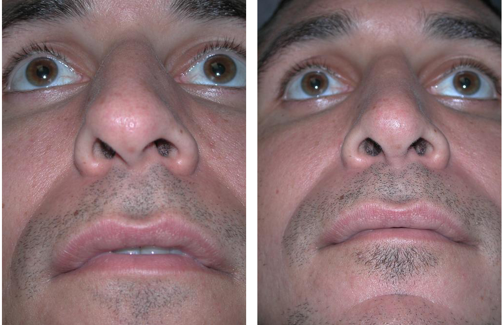 up nose view of toronto rhinoplasty on male