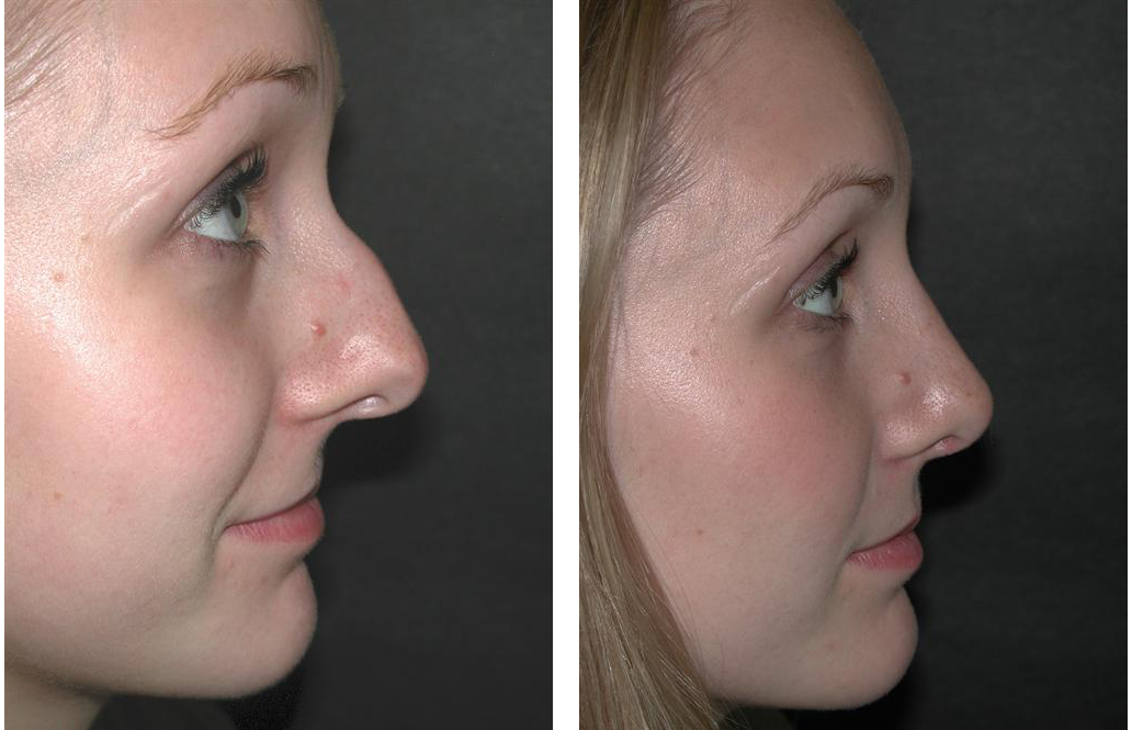 toronto nosejob before and after by dr. richard rival