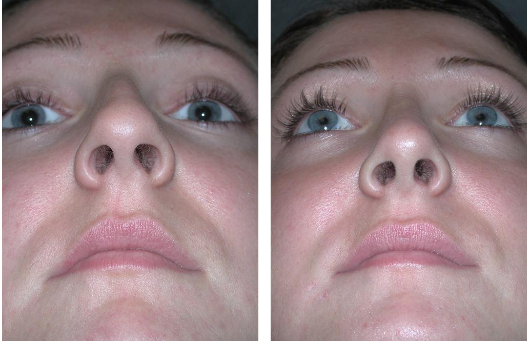Rhinplasty done by Toronto Facial Plastic Surgeon Dr. Richard Rival