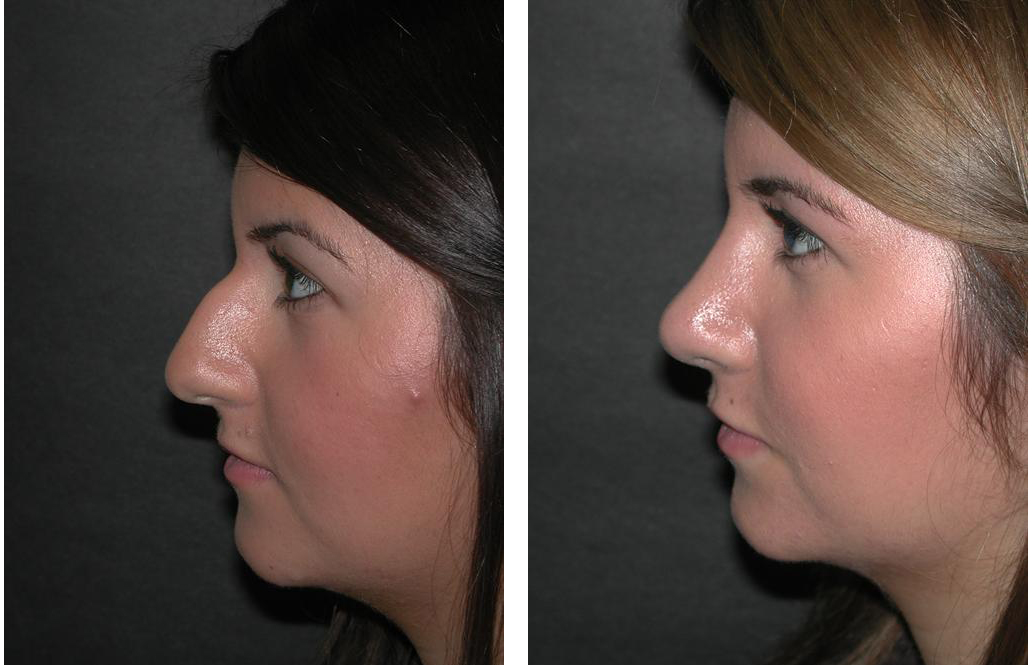 Newmarket nose job by best plastic surgeon Dr. Richard Rival
