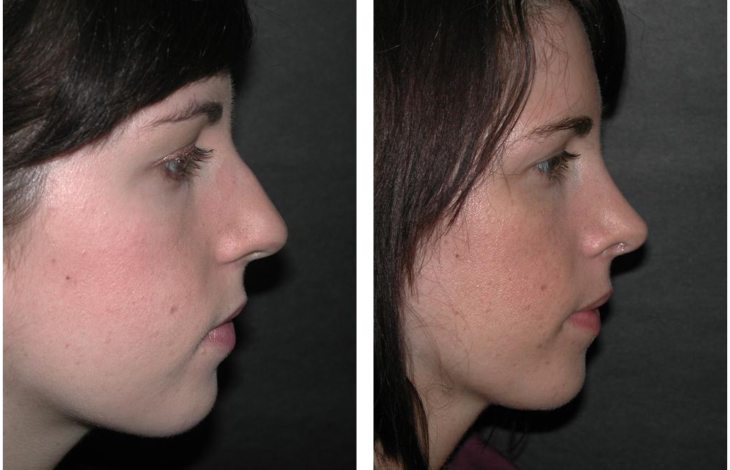 Dr. Richard Rival nosejob before and after photo