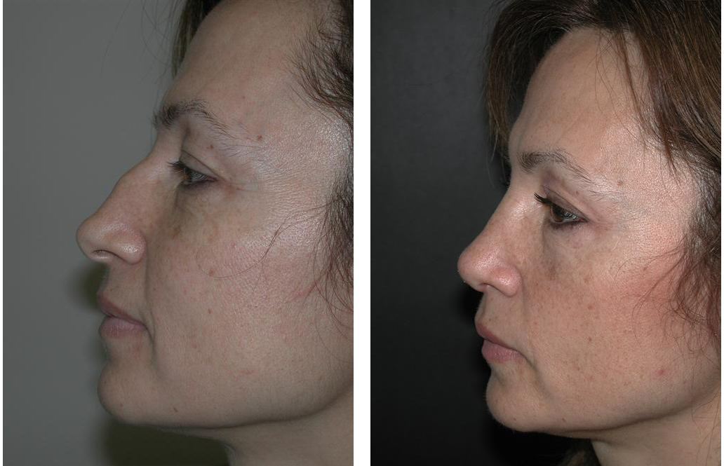Toronto Rhinoplaty before and after by Dr. Richard Rival