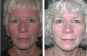 elder woman nose job done by Toronto plastic surgeon Dr. Richard Rival