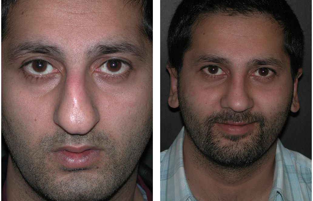 Newmarket rhinoplasty by Dr. Richard Rival