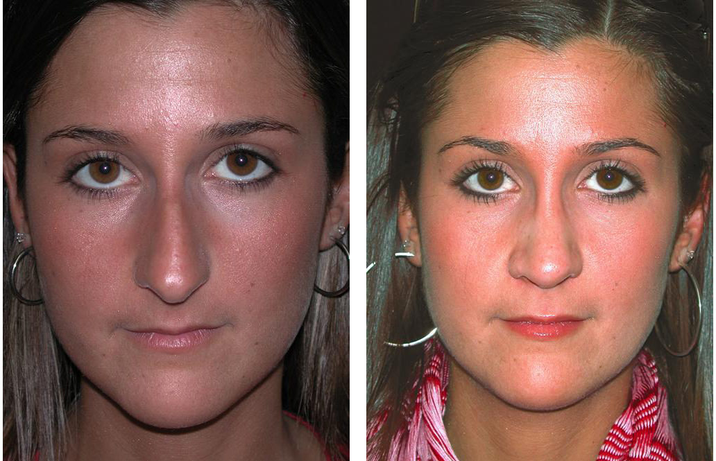 Toronto cosmetic surgeon Nose Job before and after