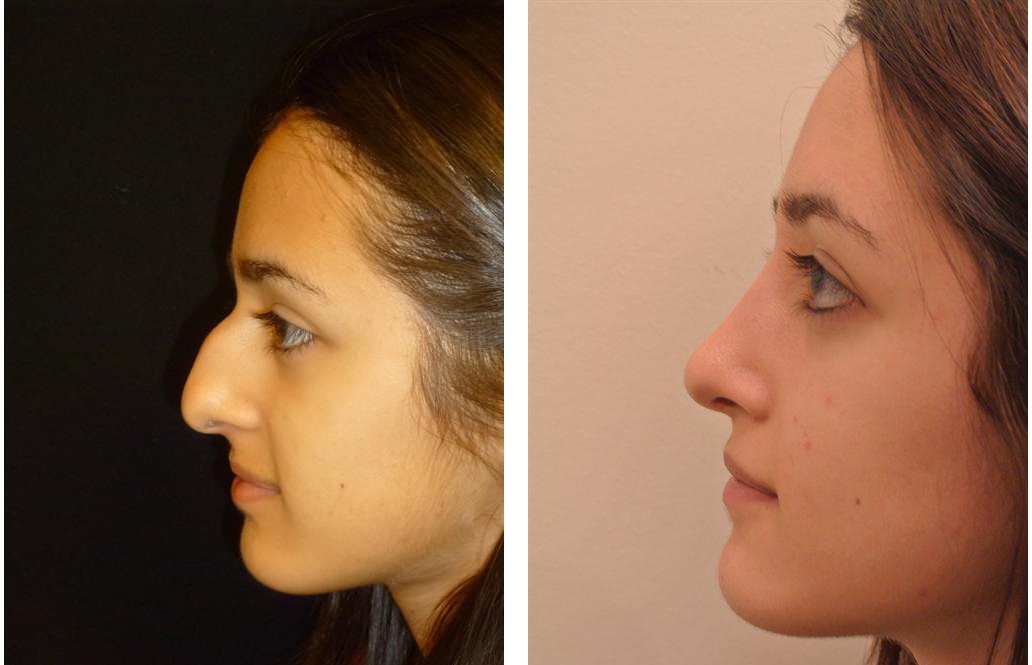 Before and after rhinoplasty photos