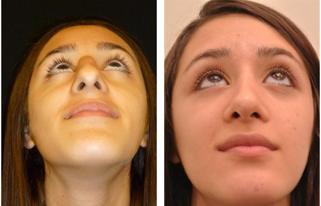 Before and after nose job by Toronto plastic surgeon