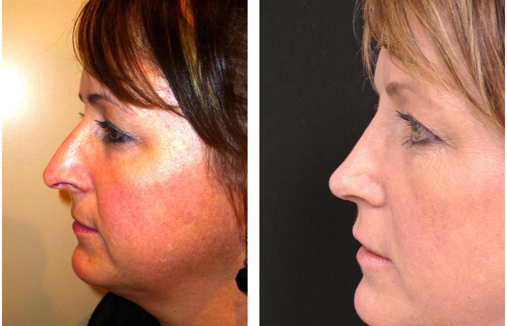 before and after photos of middle aged rhinoplasty on toronto female