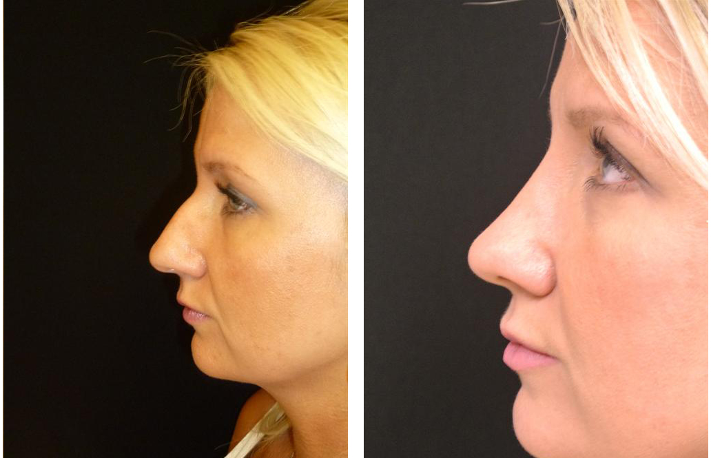 blong female before and after rhinoplasty by Dr. Richard Rival