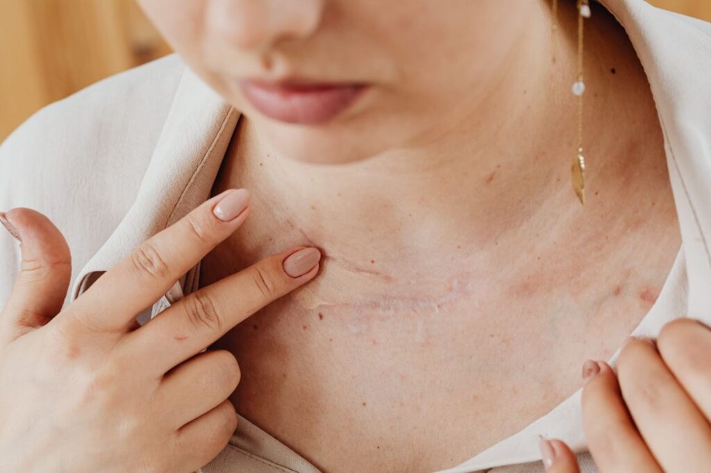 Reduce neck bruising after facelift surgery