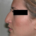 Image of patient's nose before rhinoplasty