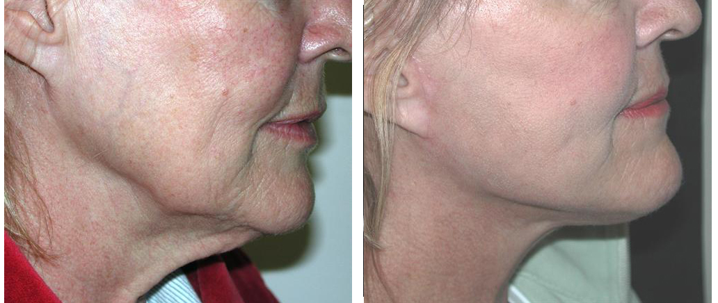 before and after facelift procedure from local toronto female from doctor richard rival