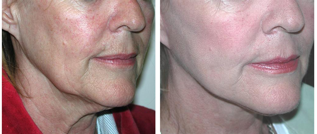 local toronto female before and after facelift procedure