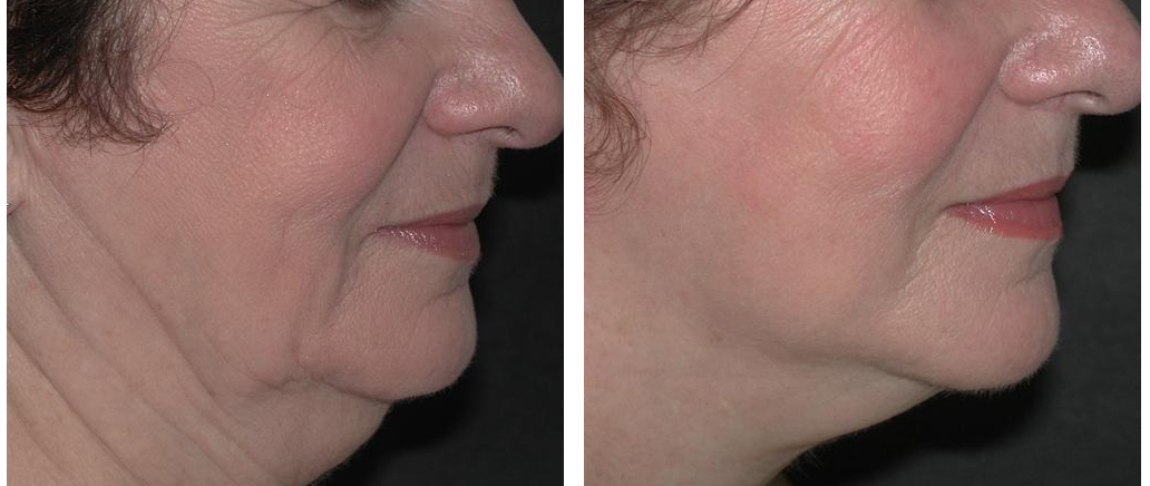 toronto female with before and after facelift from doctor richard rival