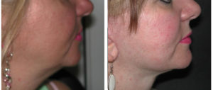facelift before and after procedure on female toronto woman
