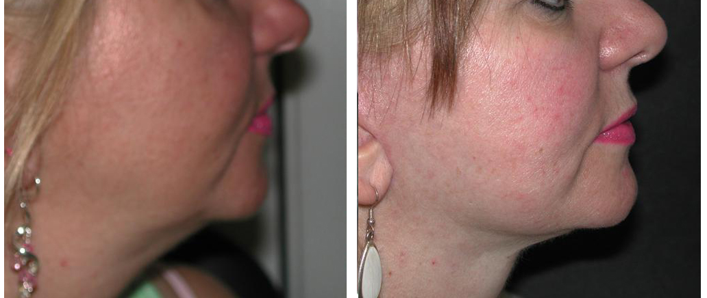 female toronto based facelift results from plastic surgeon doctor richard rival