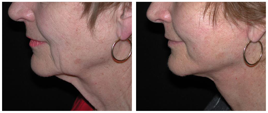 local toronto woman with facelift procedure from plastic surgeon
