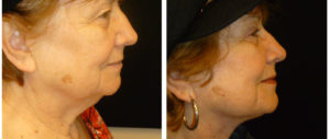 toronto female from before and after facelift procedure 