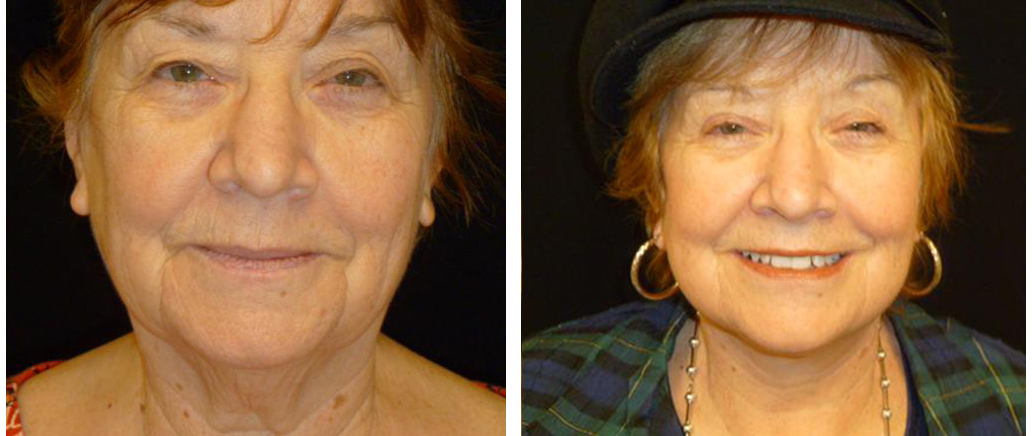 local toronto woman before and after facelift procedure