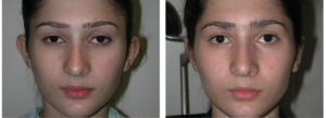 female teenager with Otoplasty procedure before and after toronto