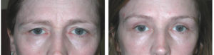 toronto woman before and after browlift procedure from richard rival