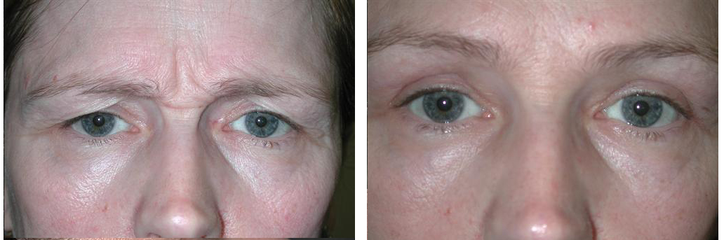 local toronto woman before and after browlift procedure