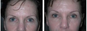 toronto female before and after browlift procedure
