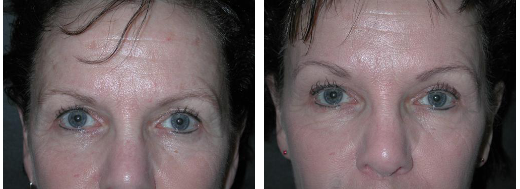 toronto woman with browlift procedure results from doctor richard rival