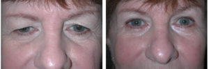 eye lift procedure from toronto plastic surgery on woman patient