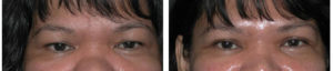 local toronto plastic surgery for eye lift on female woman