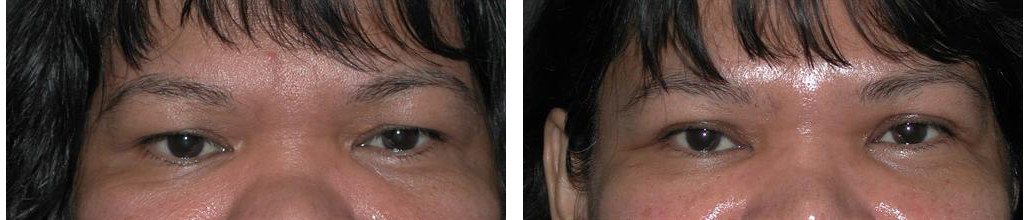 toronto eye lift procedure on female from plastic surgeon 
