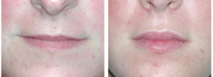 The before and after results of derma filler on female lips of Toronto woman.