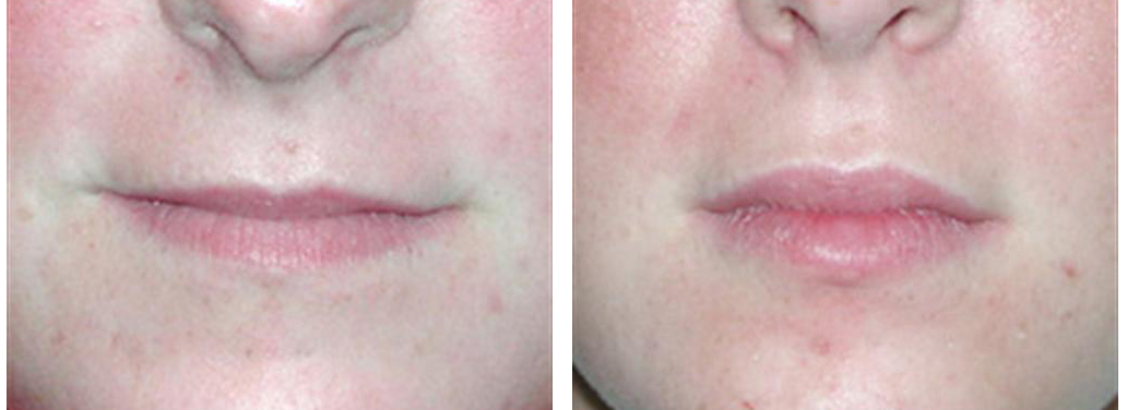 Lip augmentation from derma fillers on local toronto female