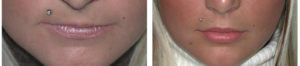 Natural lip augmentation done by Toronto facial cosmetic surgeon