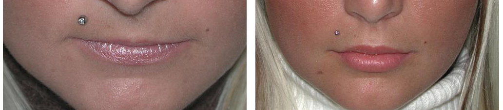 Lip augmentation from dermal fillers on before and after toronto female