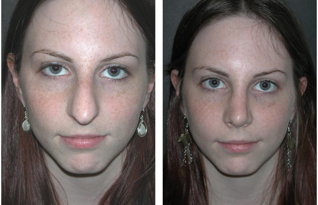 Rhinoplasty Case 42 Facial Cosmetic Surgery In Toronto From Dr Richard Rival 