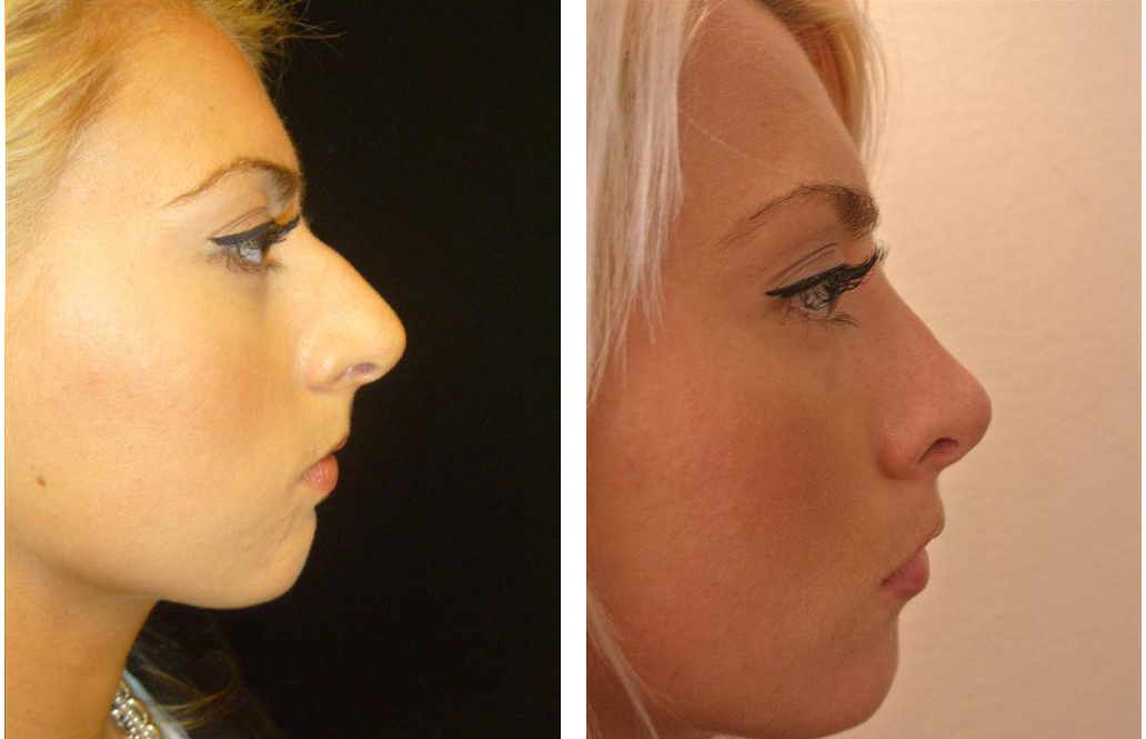 amazing before and after Rhinoplasty photo