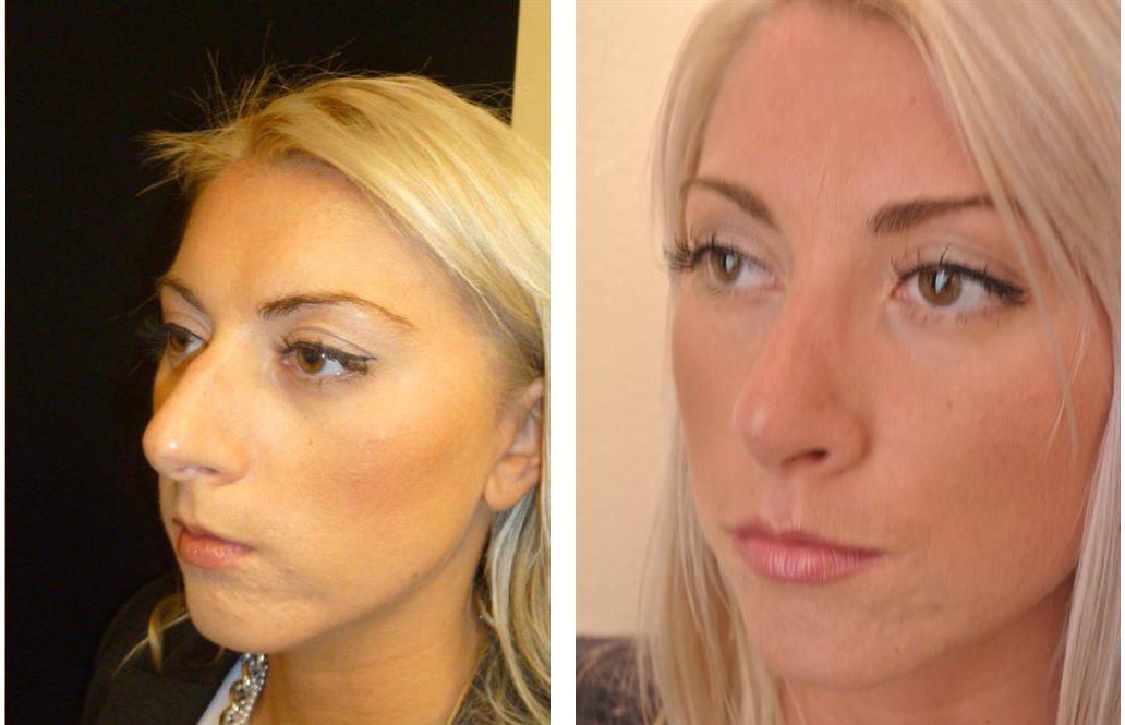 before and after rhinoplasty by Toronto cosmetic surgeon