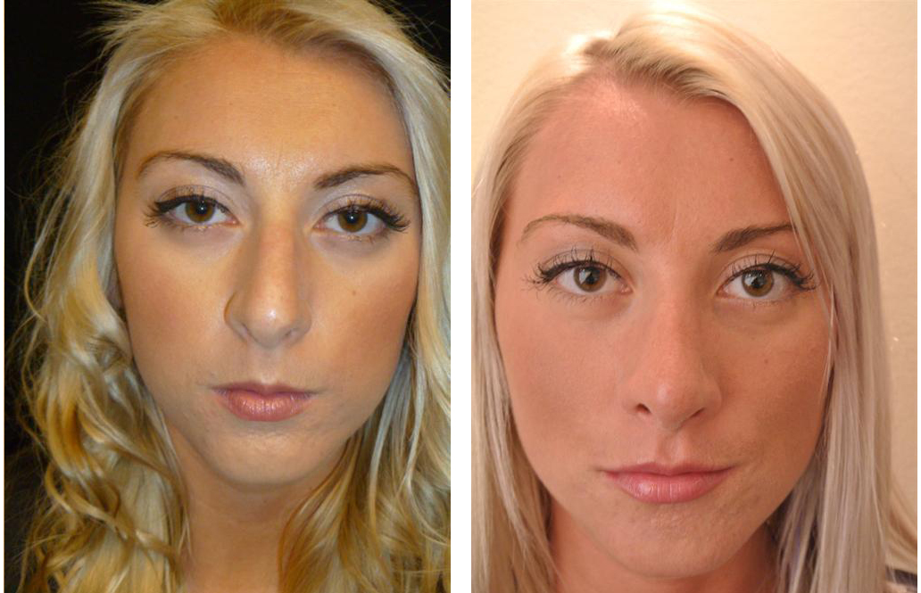 Toronto rhinoplasty surgeon before and after photos