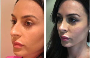 Toronto Rhinoplasty before and after by Toronto's best plastic surgeon 